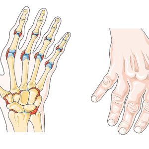 The Best Exercises for Arthritis Sufferers