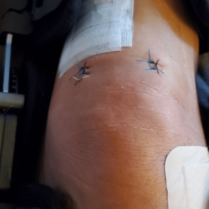 On the Mend: My Story of ACL Recovery