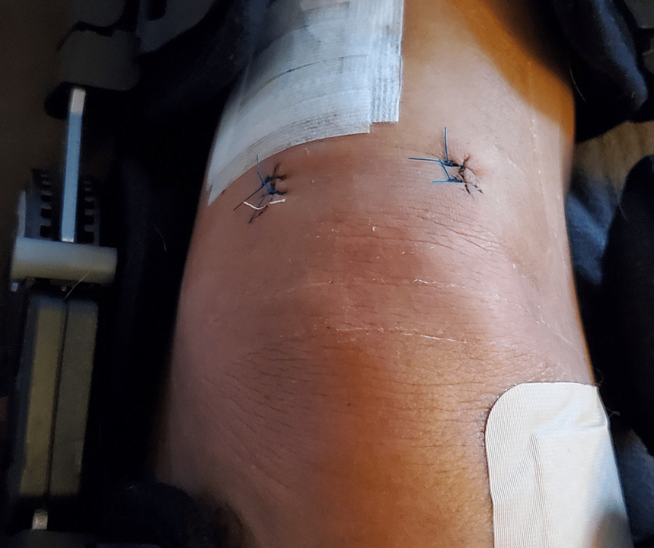 Stiches from Knee Surgery