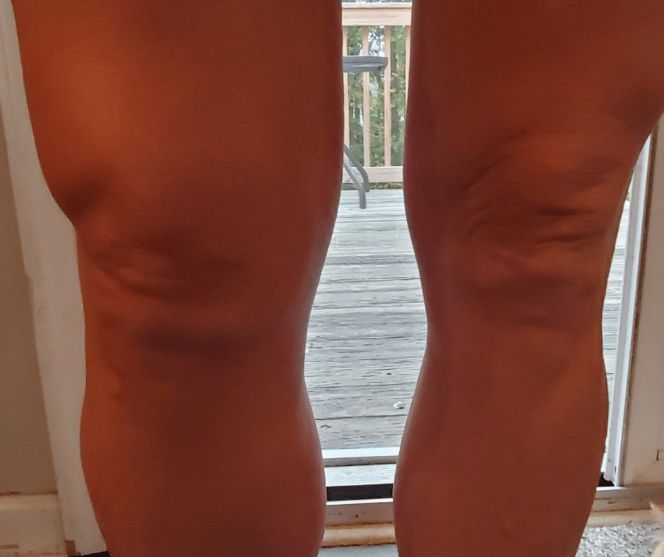 Sonofabit. I Tore My ACL – Fit 50 and Fabulous